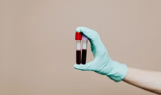Novo exame de sangue pode diferenciar infartos da 'síndrome do coração partido'