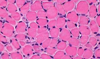 Un injerto muscular imita los efectos del ejercicio: aumenta la fuerza, la masa muscular y la densidad ósea