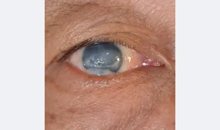 Inteligência Artificial ajuda a prevenir cegueira provocada por glaucoma