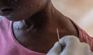 Portugal regista transmissão comunitária da nova subvariante da mpox e mais novos casos na Europa