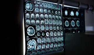 Viver em zonas carenciadas ligado a pior saúde cerebral