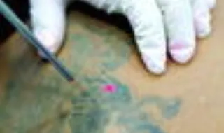 Cresce remoção de tatuagens sem regras