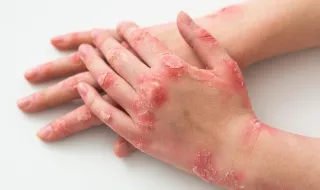 Tudo o que deve saber sobre queimaduras