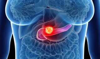 Cancro do pâncreas: medicamento aprovado nos EUA pode chegar à Europa em poucos meses
