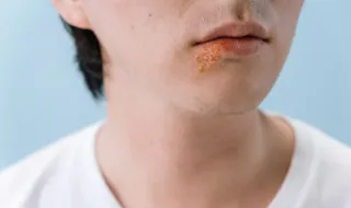 Vacina contra herpes-zóster está associada a redução de doenças cardiovasculares, revela novo estudo da Nature Medicine