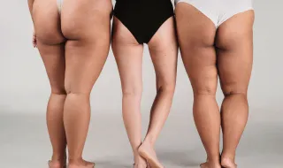 O que é harmonização glútea? Entenda como é possível mudar o formato do bumbum